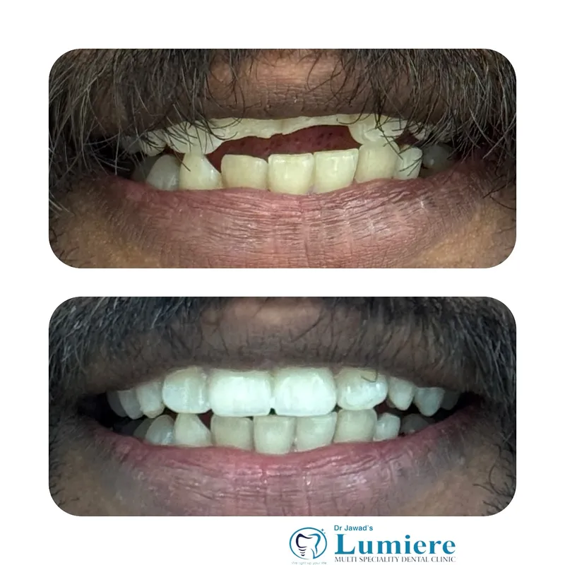 Anterior Smile Reconstruction