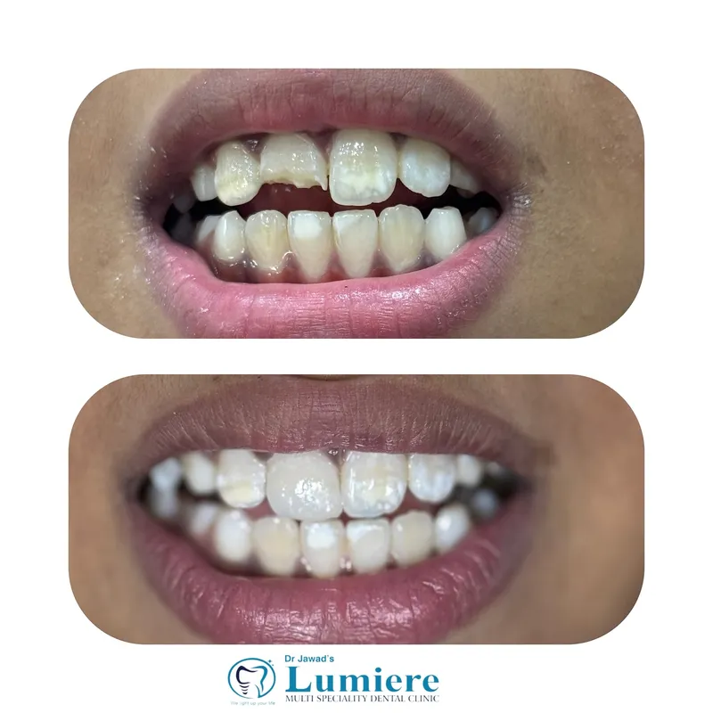 Fractured Tooth Repair