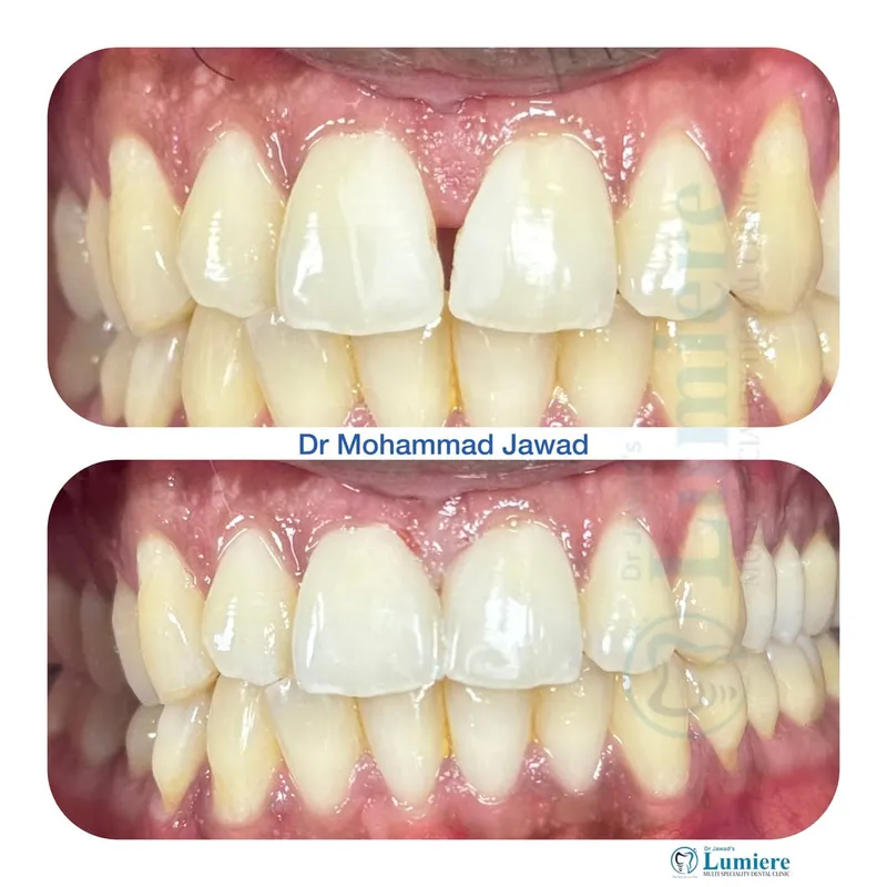 Midline Diastema Closure